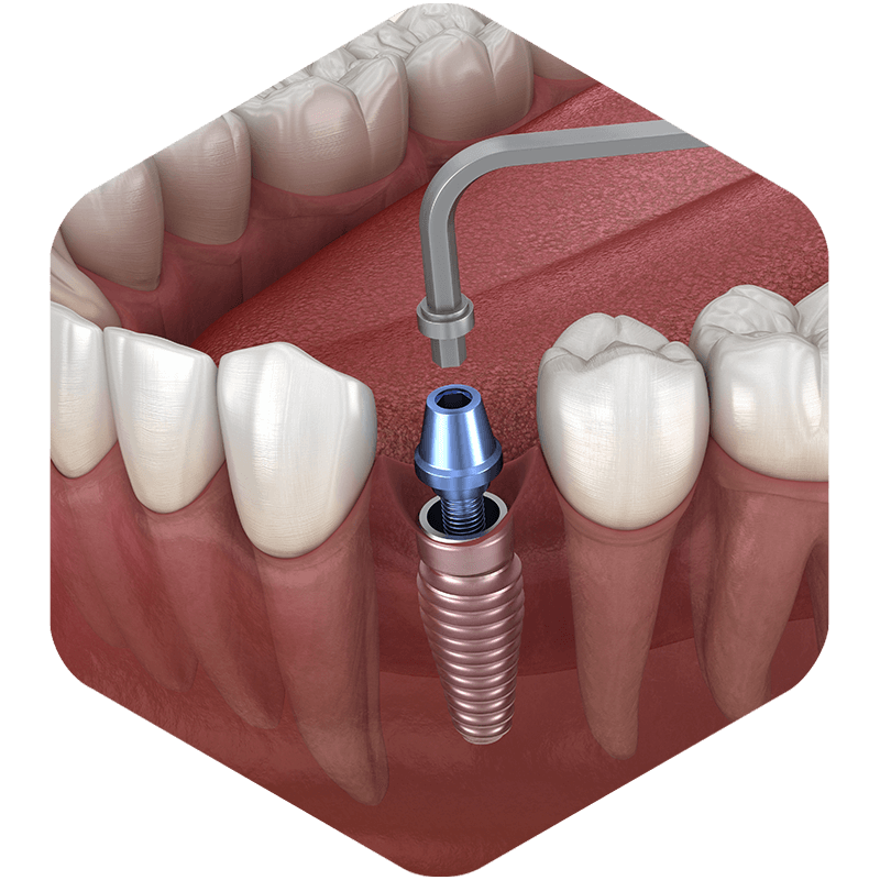 3D illustration of a dental implant with abutment.